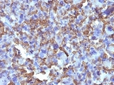 Macrophage + Histiocytoma Marker Antibody - Formalin-fixed, paraffin-embedded human Histiocytoma stained with Macrophage antibody (D11).  This image was taken for the unmodified form of this product. Other forms have not been tested.