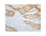 MAD2L1 / MAD2 Antibody - Colon cancer fixed with formalin (after antigen retrieval) and stained with Mad2L1 antibody, clone 17D10