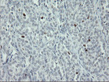 MAFB Antibody - IHC of paraffin-embedded Carcinoma of Human thyroid tissue using anti-MAFB mouse monoclonal antibody. (Heat-induced epitope retrieval by 10mM citric buffer, pH6.0, 100C for 10min).
