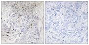 MAFF Antibody - Peptide - + Immunohistochemistry analysis of paraffin-embedded human breast carcinoma tissue, using MAFF antibody.