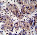 MAGEA3 Antibody - MAGEA3 Antibody immunohistochemistry of formalin-fixed and paraffin-embedded human breast carcinoma followed by peroxidase-conjugated secondary antibody and DAB staining.
