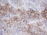 MAGEB18 Antibody - IHC of paraffin-embedded Adenocarcinoma of Human ovary tissue using anti-MAGEB18 mouse monoclonal antibody.