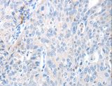 MAGEB4 Antibody - Immunohistochemistry of paraffin-embedded Human ovarian cancer using MAGEB4 Polyclonal Antibody at dilution of 1:40.