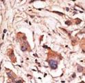 MAGED1 / NRAGE Antibody - Formalin-fixed and paraffin-embedded human cancer tissue reacted with the primary antibody, which was peroxidase-conjugated to the secondary antibody, followed by DAB staining. This data demonstrates the use of this antibody for immunohistochemistry; clinical relevance has not been evaluated. BC = breast carcinoma; HC = hepatocarcinoma.