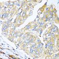 MANF / ARMET Antibody - Immunohistochemistry of paraffin-embedded human prostate cancer using MANF antibody at dilution of 1:100 (40x lens).
