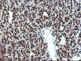 Mannose Phosphate Isomerase Antibody - IHC of paraffin-embedded Carcinoma of Human thyroid tissue using anti-MPI mouse monoclonal antibody.