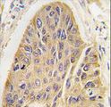 MAP2 Antibody - Formalin-fixed and paraffin-embedded human lung carcinoma tissue reacted with hMAP2-Q425 antibody, which was peroxidase-conjugated to the secondary antibody, followed by DAB staining. This data demonstrates the use of this antibody for immunohistochemistry.