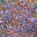 MAP2K1 / MKK1 / MEK1 Antibody - Immunohistochemical analysis of MKK1 staining in human prostate cancer formalin fixed paraffin embedded tissue section. The section was pre-treated using heat mediated antigen retrieval with sodium citrate buffer (pH 6.0). The section was then incubated with the antibody at room temperature and detected using an HRP conjugated compact polymer system. DAB was used as the chromogen. The section was then counterstained with hematoxylin and mounted with DPX.