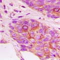 MAP2K3 / MEK3 / MKK3 Antibody - Immunohistochemical analysis of MKK3 (pT222) staining in human breast cancer formalin fixed paraffin embedded tissue section. The section was pre-treated using heat mediated antigen retrieval with sodium citrate buffer (pH 6.0). The section was then incubated with the antibody at room temperature and detected using an HRP conjugated compact polymer system. DAB was used as the chromogen. The section was then counterstained with hematoxylin and mounted with DPX.