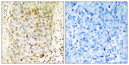 MAP3K11 / MLK3 Antibody - Immunohistochemistry analysis of paraffin-embedded human breast carcinoma tissue, using MLK3 Antibody. The picture on the right is blocked with the synthesized peptide.