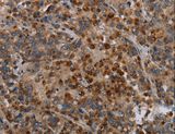 MAP3K11 / MLK3 Antibody - Immunohistochemistry of paraffin-embedded Human liver cancer using MAP3K11 Polyclonal Antibody at dilution of 1:40.