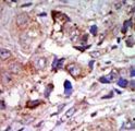 MAP3K12 Antibody - Formalin-fixed and paraffin-embedded human cancer tissue reacted with the primary antibody, which was peroxidase-conjugated to the secondary antibody, followed by AEC staining. This data demonstrates the use of this antibody for immunohistochemistry; clinical relevance has not been evaluated. BC = breast carcinoma; HC = hepatocarcinoma.