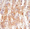 MAP3K6 / MEKK6 Antibody - Formalin-fixed and paraffin-embedded human cancer tissue reacted with the primary antibody, which was peroxidase-conjugated to the secondary antibody, followed by DAB staining. This data demonstrates the use of this antibody for immunohistochemistry; clinical relevance has not been evaluated. BC = breast carcinoma; HC = hepatocarcinoma.