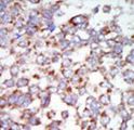 MAP3K7 / TAK1 Antibody - Formalin-fixed and paraffin-embedded human cancer tissue reacted with the primary antibody, which was peroxidase-conjugated to the secondary antibody, followed by AEC staining. This data demonstrates the use of this antibody for immunohistochemistry; clinical relevance has not been evaluated. BC = breast carcinoma; HC = hepatocarcinoma.