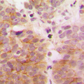 MAP3K7 / TAK1 Antibody - Immunohistochemical analysis of TAK1 staining in human breast cancer formalin fixed paraffin embedded tissue section. The section was pre-treated using heat mediated antigen retrieval with sodium citrate buffer (pH 6.0). The section was then incubated with the antibody at room temperature and detected using an HRP conjugated compact polymer system. DAB was used as the chromogen. The section was then counterstained with hematoxylin and mounted with DPX.