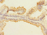 MAP4K5 Antibody - Immunohistochemistry of paraffin-embedded human prostate cancer at dilution 1:100