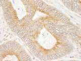 MAP7 Antibody - Detection of Human MAP7 by Immunohistochemistry. Sample: FFPE section of human colon carcinoma. Antibody: Affinity purified rabbit anti-MAP7 used at a dilution of 1:1000 (1 Detection: DAB.