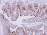 MAP7 Antibody - IHC of paraffin-embedded Colon ca, using MAP7 antibody at 1:500 dilution.