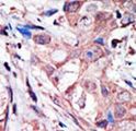 MAPK10 / JNK3 Antibody - Formalin-fixed and paraffin-embedded human cancer tissue reacted with the primary antibody, which was peroxidase-conjugated to the secondary antibody, followed by AEC staining. This data demonstrates the use of this antibody for immunohistochemistry; clinical relevance has not been evaluated. BC = breast carcinoma; HC = hepatocarcinoma.