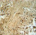 MAPK14 / p38 Antibody - MAPK14 Antibody (T180/Y182)immunohistochemistry of formalin-fixed and paraffin-embedded human lung carcinoma followed by peroxidase-conjugated secondary antibody and DAB staining. This data demonstrates the use of the MAPK14 Antibody (T180/Y182) for immunohistochemistry.