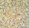 MAPK1IP1L Antibody - MAPK1IP1L Antibody IHC of formalin-fixed and paraffin-embedded kidney carcinoma followed by peroxidase-conjugated secondary antibody and DAB staining. This data demonstrates the use of the MAPK1IP1L Antibody for immunohistochemistry.