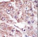 MARK2 Antibody - Formalin-fixed and paraffin-embedded human cancer tissue reacted with the primary antibody, which was peroxidase-conjugated to the secondary antibody, followed by AEC staining. This data demonstrates the use of this antibody for immunohistochemistry; clinical relevance has not been evaluated. BC = breast carcinoma; HC = hepatocarcinoma.