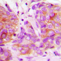 MARK2 Antibody - Immunohistochemical analysis of MARK2 staining in human breast cancer formalin fixed paraffin embedded tissue section. The section was pre-treated using heat mediated antigen retrieval with sodium citrate buffer (pH 6.0). The section was then incubated with the antibody at room temperature and detected using an HRP conjugated compact polymer system. DAB was used as the chromogen. The section was then counterstained with hematoxylin and mounted with DPX.
