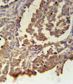 MC2R / ACTHR / ACTH Receptor Antibody - MC2R Antibody immunohistochemistry of formalin-fixed and paraffin-embedded human skin carcinoma followed by peroxidase-conjugated secondary antibody and DAB staining.