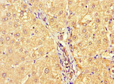 MCA32 Antibody - Immunohistochemistry of paraffin-embedded human liver cancer at dilution 1:100