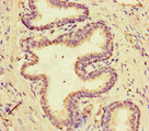 MCIDAS / MCIN Antibody - Immunohistochemistry of paraffin-embedded human prostate cancer at dilution of 1:100