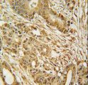 MCM2 Antibody - MCM2 Antibody immunohistochemistry of formalin-fixed and paraffin-embedded human colon carcinoma followed by peroxidase-conjugated secondary antibody and DAB staining.