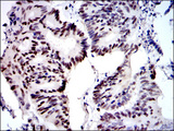 MCM2 Antibody - IHC of paraffin-embedded colon cancer tissues using MCM2 mouse monoclonal antibody with DAB staining.