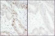 MCM2 Antibody - Detection of Human Phospho MCM2 (S40/S41) by Immunohistochemistry. Samples: FFPE serial sections of human colon carcinoma. Mock phosphatase treated section (left) and calf intestinal phosphatase-treated section (right). Antibody: Affinity purified rabbit anti-Phospho MCM2 (S40/S41) ( Lot 2) used at a dilution of 1:200 (1 ug/ml). Detection: DAB.