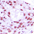 MCM4 Antibody - Immunohistochemical analysis of MCM4 staining in human breast cancer formalin fixed paraffin embedded tissue section. The section was pre-treated using heat mediated antigen retrieval with sodium citrate buffer (pH 6.0). The section was then incubated with the antibody at room temperature and detected using an HRP conjugated compact polymer system. DAB was used as the chromogen. The section was then counterstained with hematoxylin and mounted with DPX.