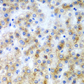 MD-1 / LY86 Antibody - Immunohistochemistry of paraffin-embedded human liver cancer tissue.