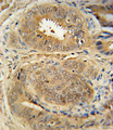 MDM2 Antibody - Mdm2 Antibody immunohistochemistry of formalin-fixed and paraffin-embedded human prostate carcinoma followed by peroxidase-conjugated secondary antibody and DAB staining.