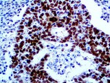 MDM2 Antibody - IHC of MDM2 on an FFPE Testicular Cancer Tissue