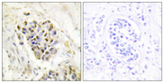 MED1 / TRAP220 Antibody - Immunohistochemistry analysis of paraffin-embedded human breast carcinoma tissue, using MED1 Antibody. The picture on the right is blocked with the synthesized peptide.