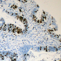 MED1 / TRAP220 Antibody - Immunohistochemical analysis of TRAP220 (pT1457) staining in human colon cancer formalin fixed paraffin embedded tissue section. The section was pre-treated using heat mediated antigen retrieval with sodium citrate buffer (pH 6.0). The section was then incubated with the antibody at room temperature and detected using an HRP conjugated compact polymer system. DAB was used as the chromogen. The section was then counterstained with hematoxylin and mounted with DPX.