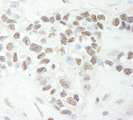MED12 Antibody - Detection of Human MED12 by Immunohistochemistry. Sample: FFPE section of human breast carcinoma. Antibody: Affinity purified rabbit anti-MED12 used at a dilution of 1:1000 (1 Detection: DAB.