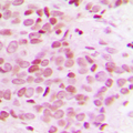 MED12 Antibody - Immunohistochemical analysis of TRAP230 staining in human breast cancer formalin fixed paraffin embedded tissue section. The section was pre-treated using heat mediated antigen retrieval with sodium citrate buffer (pH 6.0). The section was then incubated with the antibody at room temperature and detected using an HRP conjugated compact polymer system. DAB was used as the chromogen. The section was then counterstained with hematoxylin and mounted with DPX.