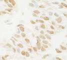 MED13L Antibody - Detection of Human MED13L by Immunohistochemistry. Sample: FFPE section of human breast carcinoma. Antibody: Affinity purified rabbit anti-MED13L used at a dilution of 1:1000 (1 ug/ml). Detection: DAB.