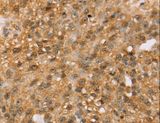MED22 Antibody - Immunohistochemistry of paraffin-embedded Human breast cancer using MED22 Polyclonal Antibody at dilution of 1:50.