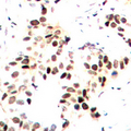 MEF2A / MEF2 Antibody - Immunohistochemical analysis of MEF2A (pT312) staining in human breast cancer formalin fixed paraffin embedded tissue section. The section was pre-treated using heat mediated antigen retrieval with sodium citrate buffer (pH 6.0). The section was then incubated with the antibody at room temperature and detected using an HRP conjugated compact polymer system. DAB was used as the chromogen. The section was then counterstained with hematoxylin and mounted with DPX.