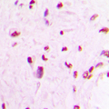MEF2C Antibody - Immunohistochemical analysis of MEF2C staining in human lung cancer formalin fixed paraffin embedded tissue section. The section was pre-treated using heat mediated antigen retrieval with sodium citrate buffer (pH 6.0). The section was then incubated with the antibody at room temperature and detected using an HRP conjugated compact polymer system. DAB was used as the chromogen. The section was then counterstained with hematoxylin and mounted with DPX.