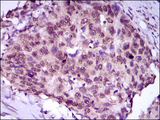 MEF2C Antibody - IHC of paraffin-embedded esophageal cancer tissues using MEF2C mouse monoclonal antibody with DAB staining.