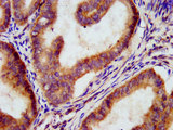 MEGF9 / EGFL5 Antibody - Immunohistochemistry image at a dilution of 1:300 and staining in paraffin-embedded human endometrial cancer performed on a Leica BondTM system. After dewaxing and hydration, antigen retrieval was mediated by high pressure in a citrate buffer (pH 6.0) . Section was blocked with 10% normal goat serum 30min at RT. Then primary antibody (1% BSA) was incubated at 4 °C overnight. The primary is detected by a biotinylated secondary antibody and visualized using an HRP conjugated SP system.