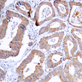 MEK1 + MEK2 Antibody - Immunohistochemical analysis of MKK1/2 (pS218/222) staining in human colon cancer formalin fixed paraffin embedded tissue section. The section was pre-treated using heat mediated antigen retrieval with sodium citrate buffer (pH 6.0). The section was then incubated with the antibody at room temperature and detected using an HRP conjugated compact polymer system. DAB was used as the chromogen. The section was then counterstained with hematoxylin and mounted with DPX.