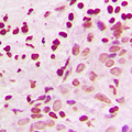 Antibody - Immunohistochemical analysis of MKK3/6 staining in human breast cancer formalin fixed paraffin embedded tissue section. The section was pre-treated using heat mediated antigen retrieval with sodium citrate buffer (pH 6.0). The section was then incubated with the antibody at room temperature and detected using an HRP conjugated compact polymer system. DAB was used as the chromogen. The section was then counterstained with hematoxylin and mounted with DPX.