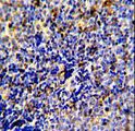MER / MERTK Antibody - Formalin-fixed and paraffin-embedded human lymphoma reacted with MERTK Antibody, which was peroxidase-conjugated to the secondary antibody, followed by DAB staining. This data demonstrates the use of this antibody for immunohistochemistry; clinical relevance has not been evaluated.